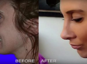 fat transfer to face