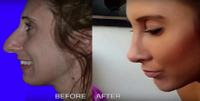 fat transfer to face